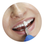 Facetas de Resinas