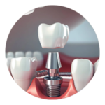 implantes dentarios
